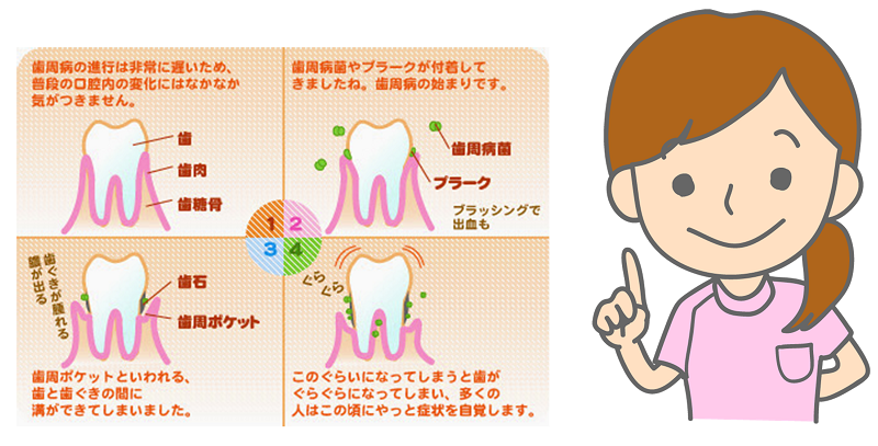 歯周病とは イラストで説明 歯周病の治療方法まとめ